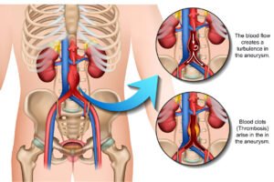 Are Chinese Americans willing to undergo abdominal aortic aneurysm screening?